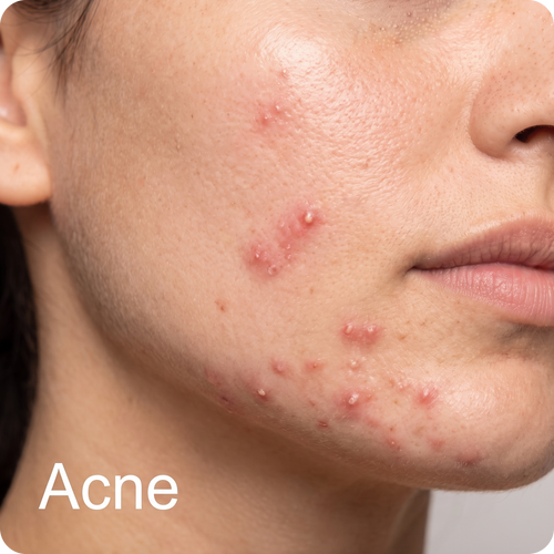 Acne