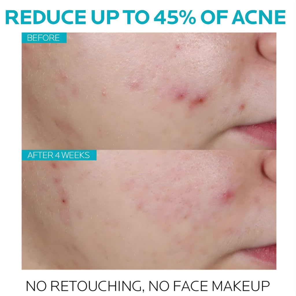 La Roche-Posay Effaclar Salicylic Acid Acne