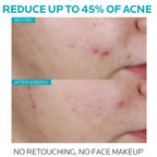 La Roche-Posay Effaclar Salicylic Acid Acne