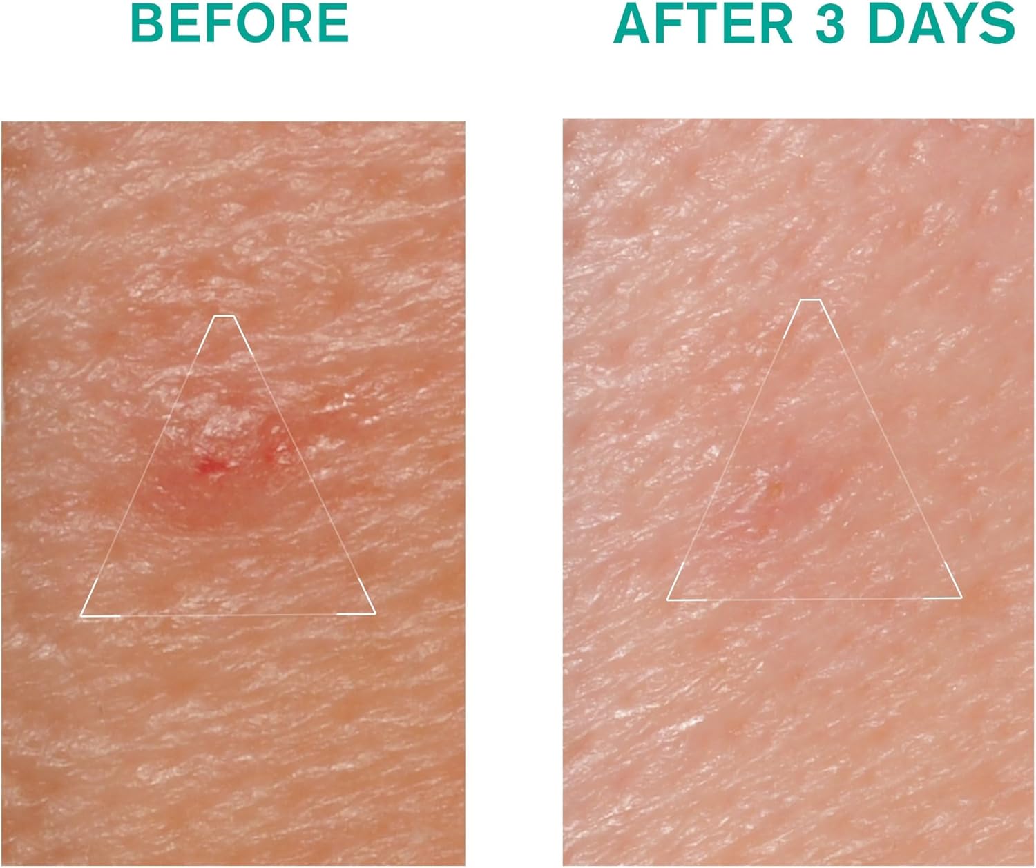 Uriage Hyseac Local Skin Care