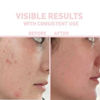 Bionnex The Nordea Purifying Salicylic Acid Serum For Acne-Prone Skin