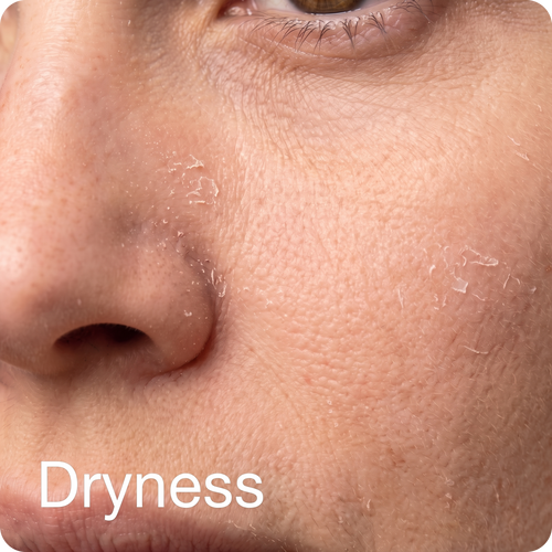 Dryness