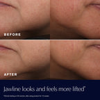 Refect Beauty before and after comparison showing a more lifted and firmer jawline after using Estée Lauder moisturizer