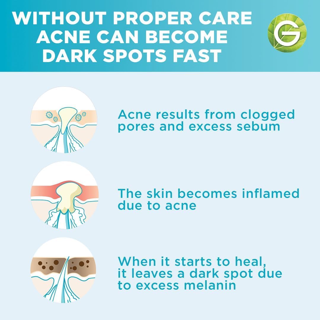 Refect Beauty infographic showing the progression of acne from clogged pores to inflammation and dark spots