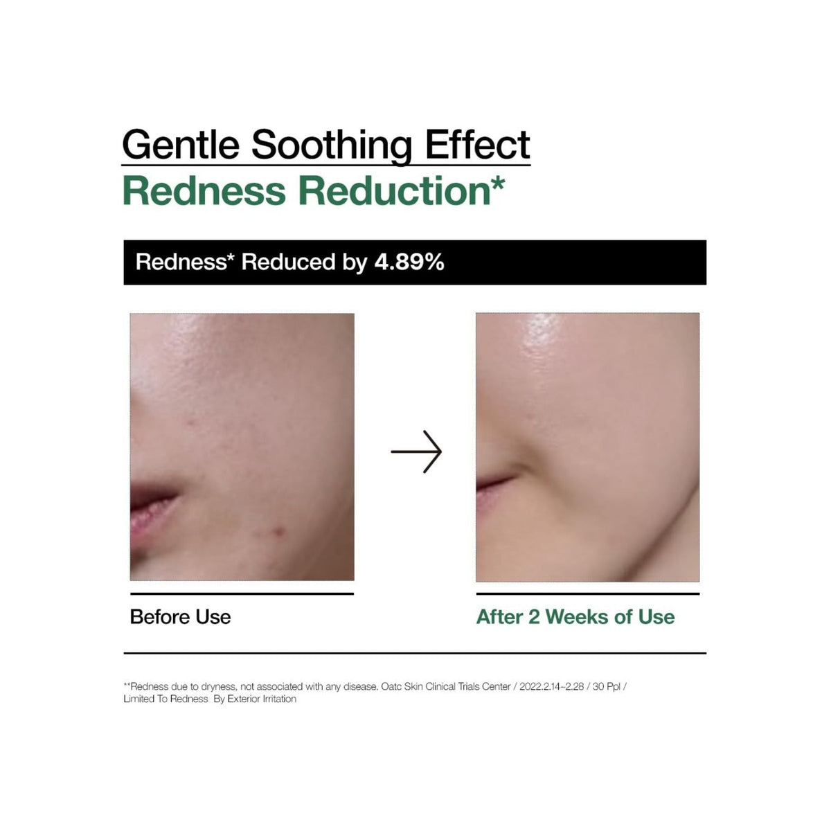 Refect Beauty clinical comparison showing skin redness reduction after using Anua Heartleaf 80% Moisture Soothing Ampoule