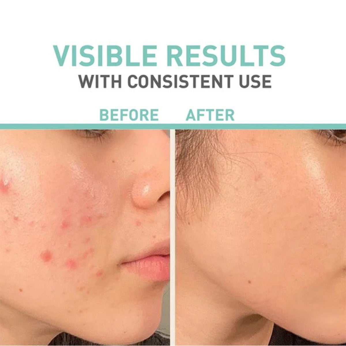 Refect Beauty Bionnex Rensaderm cream before and after comparison showing reduced acne and redness on oily skin