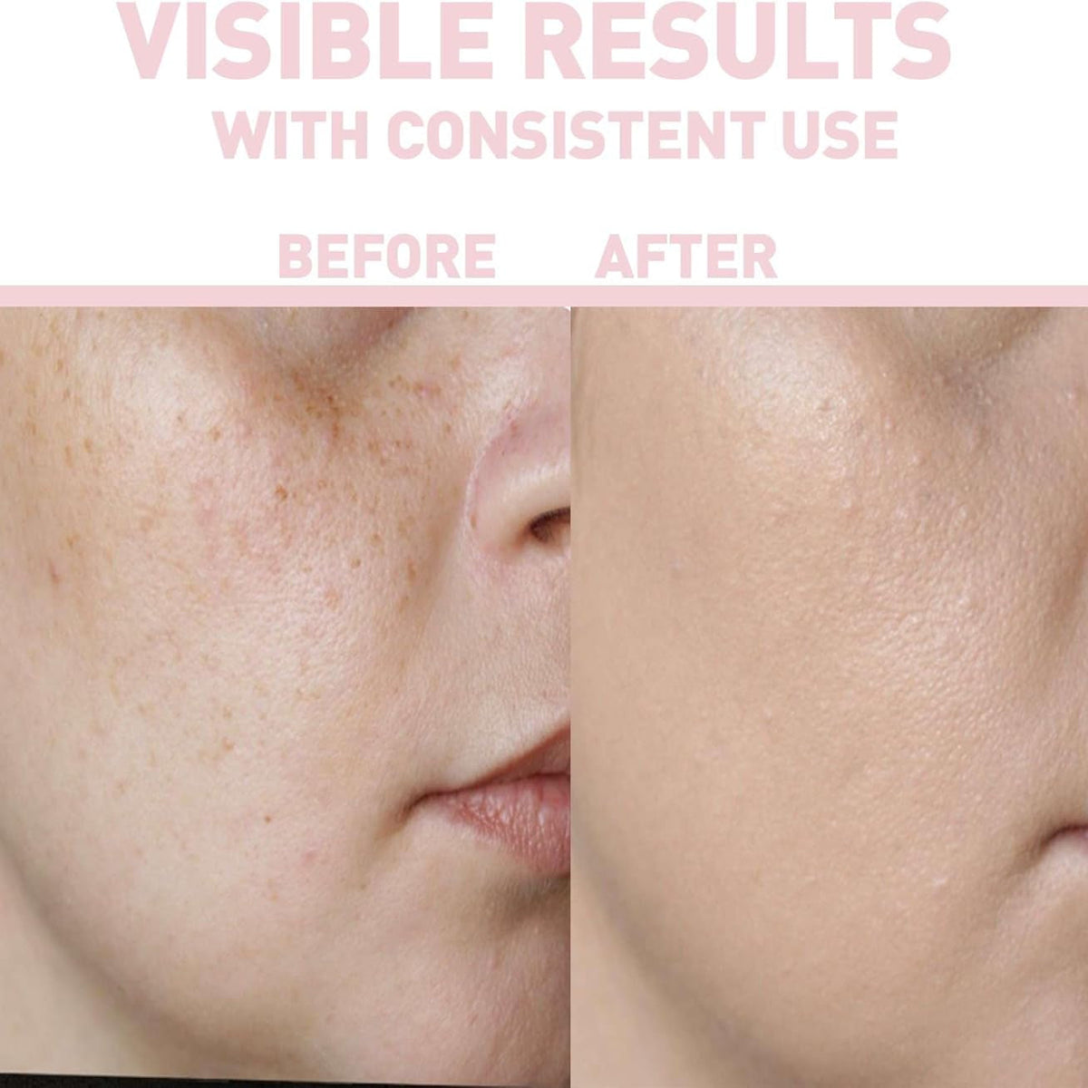 Refect Beauty Bionnex THE NORDEA Vitamin C serum before and after skin brightening results showing reduced dark spots