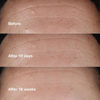 Refect Beauty Clinique Smart Clinical Repair Serum before and after results showing reduced forehead wrinkles