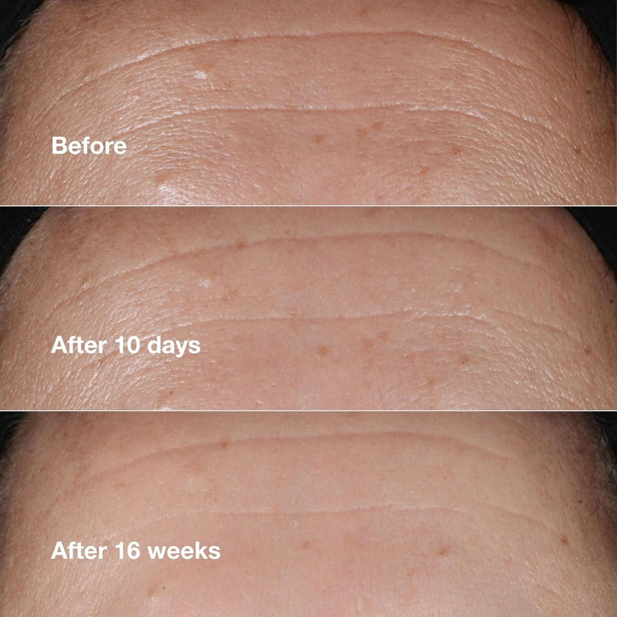 Refect Beauty Clinique Smart Clinical Repair Serum before and after results showing reduced forehead wrinkles