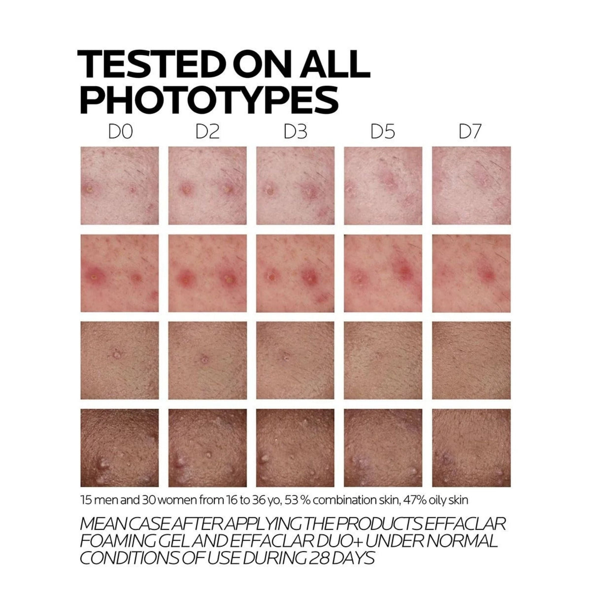 Refect Beauty clinical results chart showing skin improvement across different phototypes after using Effaclar Duo+M