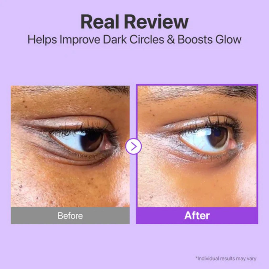Refect Beauty before and after comparison showing reduced dark circles and smoother skin after using eye cream