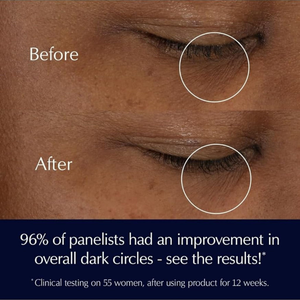 Refect Beauty before and after comparison showing reduced dark circles and fine lines around the eye area