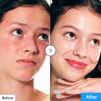 Refect Beauty Eqqualberry Hyaltoin Flooding Serum before and after comparison showing reduced redness and hydrated skin