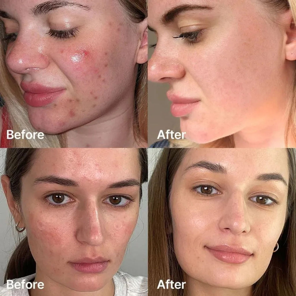 Refect Beauty Medicube Red Succinic Acid Serum before and after results showing clearer skin and reduced blemishes