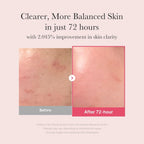 Refect Beauty Medicube TXA Niacinamide 15 Serum before and after skin clarity results after 72 hours of use