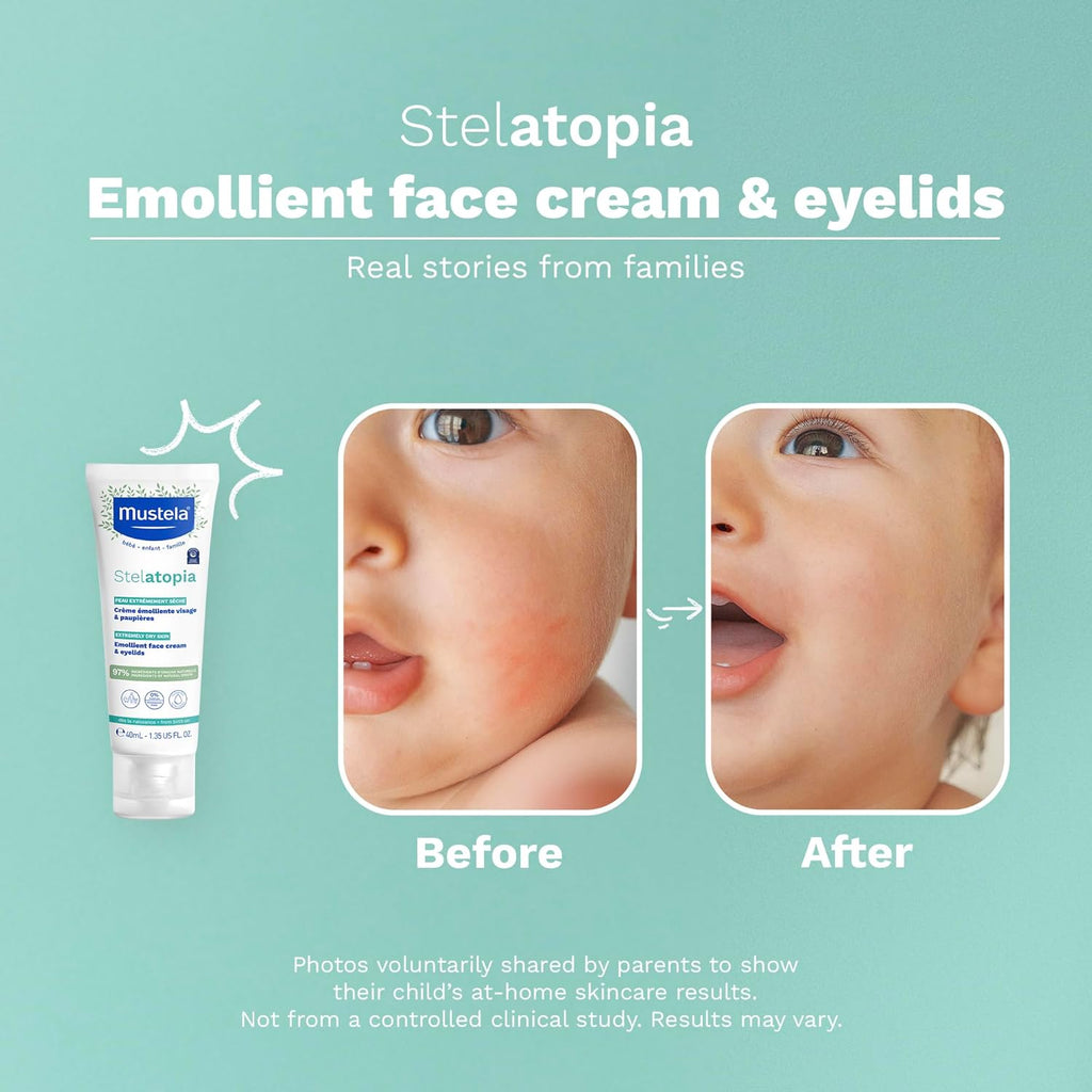 Refect Beauty Mustela Stelatopia emollient face cream showing before and after results on a baby with eczema-prone skin