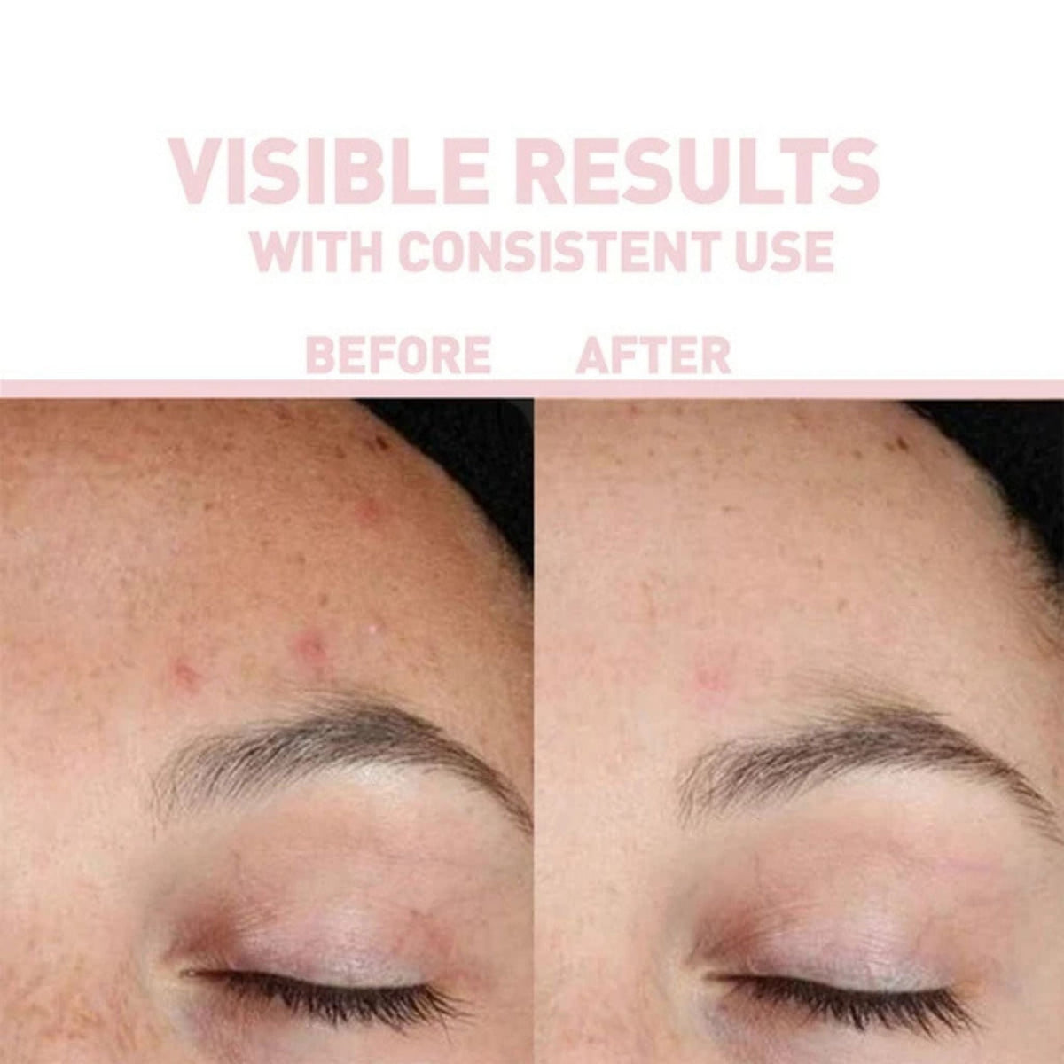 Refect Beauty Bionnex The Nordea 1% Retinol Serum before and after comparison showing improved skin texture