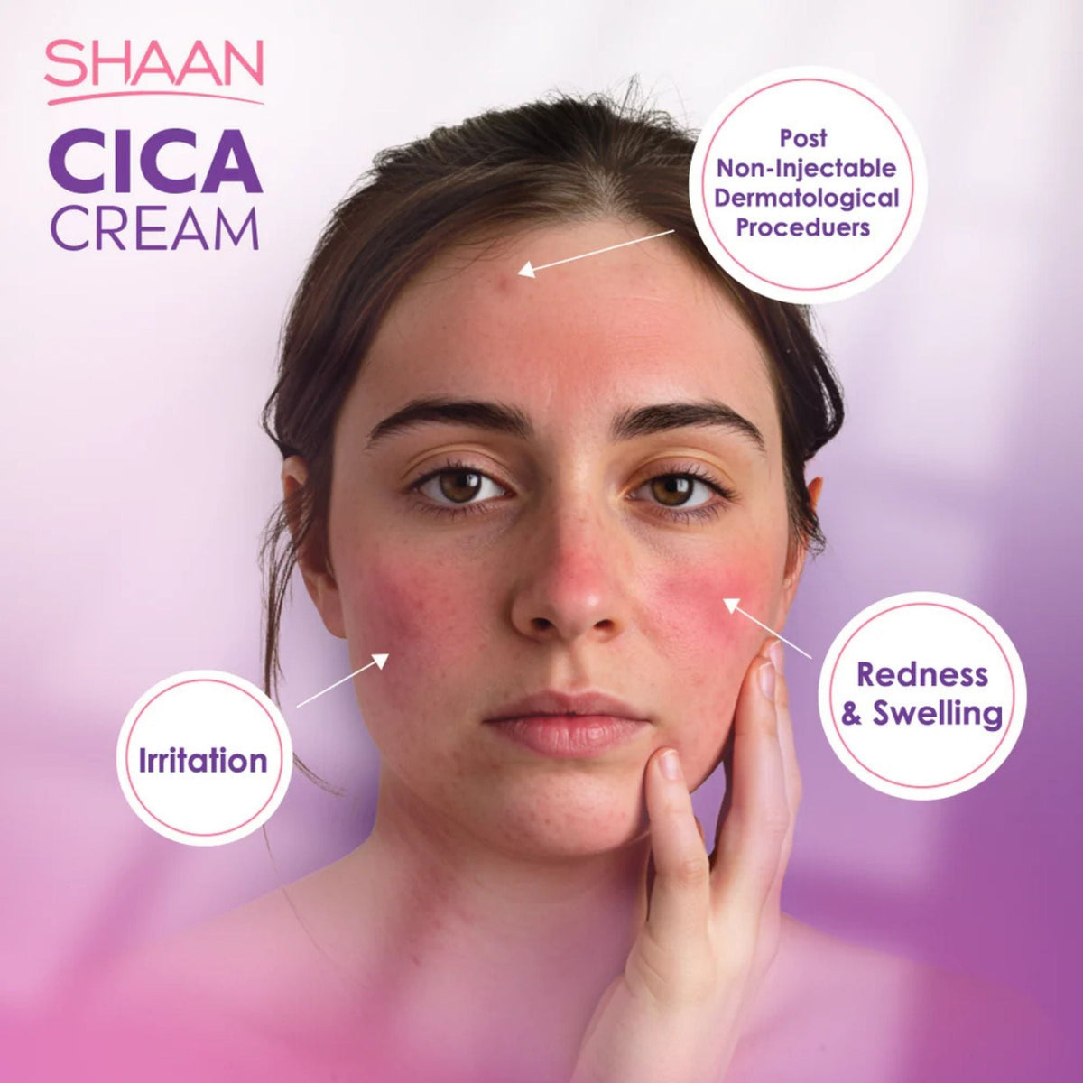 Refect Beauty Shaan CICA Cream for soothing irritated, red, and swollen skin after dermatological procedures.