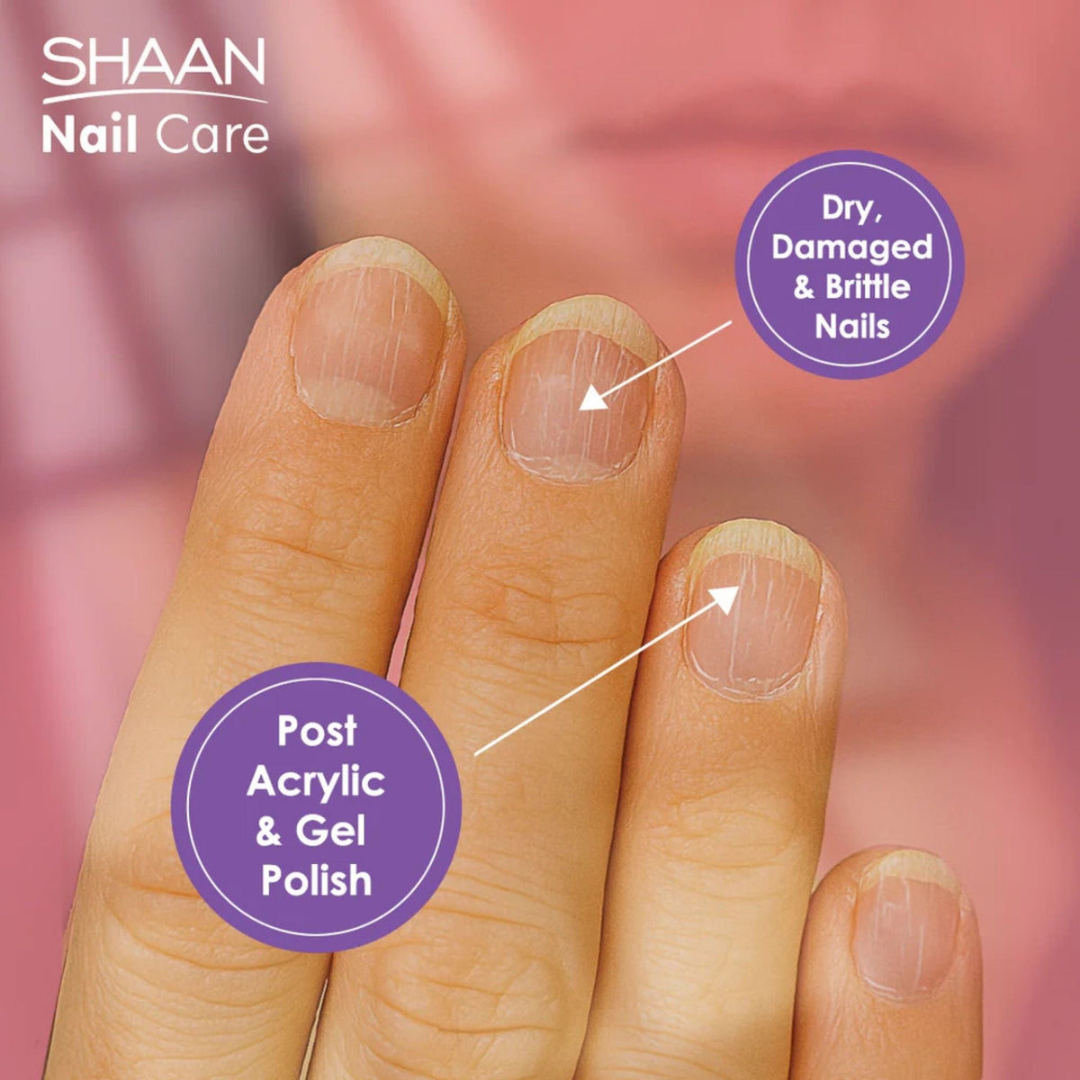 Refect Beauty Shaan Nail Care Serum applied to dry, brittle nails damaged from acrylic and gel polish treatments.