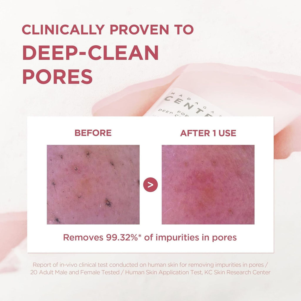 Refect Beauty clinical before and after results of SKIN1004 Centella Poremizing Deep Cleansing Foam on skin pores